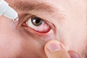 Ojos rojos por alergia